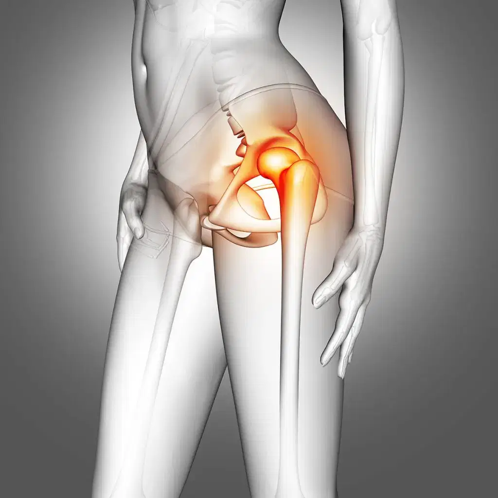 3d female medical figure with hip bone highlighted to show hip replacement