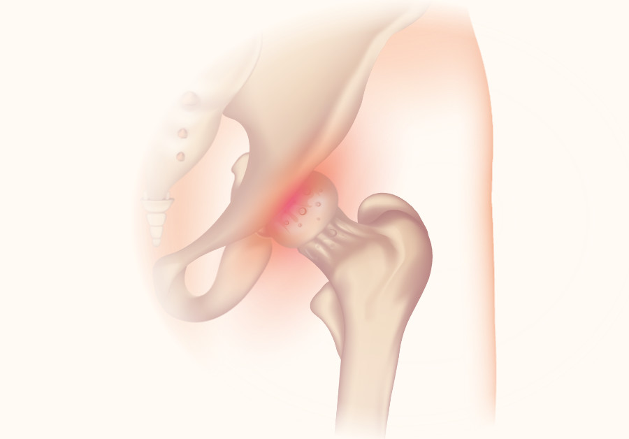 Osteoarthritis in the hip.