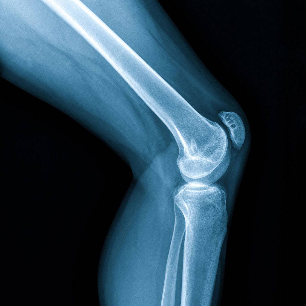 knee joint xray